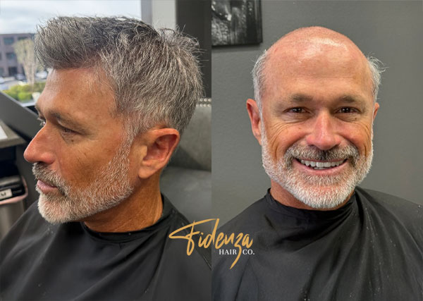 Men’s Hair Replacement in San Diego: Costs, Results & What to Expect